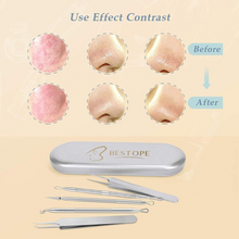 Load image into Gallery viewer, BESTOPE PRO Blackhead Remover Comedone Squeezer Set Tweezers Set with Metal Box Blackhead Remover Made of High-Quality Stainless Steel Acne Blackhead Remover Extractor Tools 6 Pieces