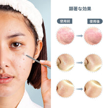 Load image into Gallery viewer, 毛抜き 角栓取り 専用6本セット アクネプッシャーキット ニキビ取り 黒ずみ取り 角栓 いちご 鼻ケア ピンセット コメドプッシャー 収納ケース付き 携帯便利 6本セット